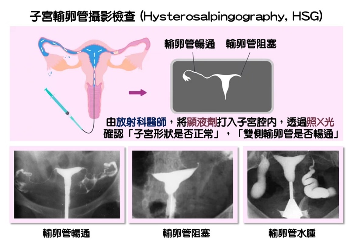子宮輸卵管攝影